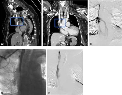 Assessment of dysfunctional tunneled hemodialysis catheters and outcome of endovascular salvage techniques: a simple solution to a complex problem